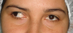 exotropia