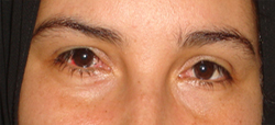 exotropia
