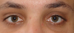 exotropia