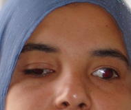 exotropia