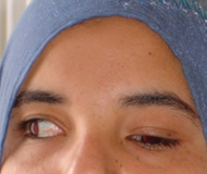 exotropia