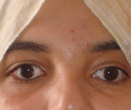 exotropia