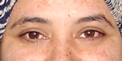 pattern esotropia