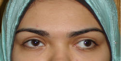pattern esotropia